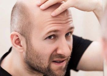 BaldHead : ఈ ఆయిల్ రాసుకుంటే.. బట్టతల మాయం..