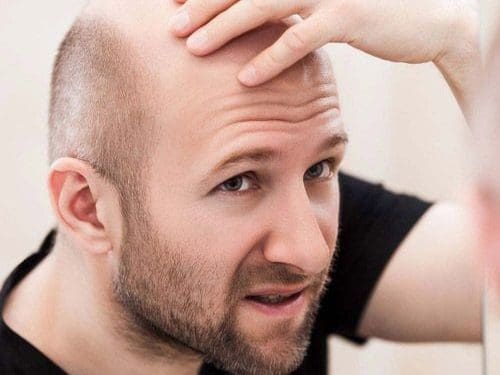 BaldHead : ఈ ఆయిల్ రాసుకుంటే.. బట్టతల మాయం..