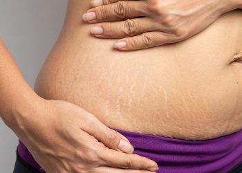 Stretch Marks : స్ట్రెచ్ మార్క్స్ బాధిస్తున్నాయా.. ఈ చిట్కా మీకోసమే..