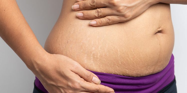 Stretch Marks : స్ట్రెచ్ మార్క్స్ బాధిస్తున్నాయా.. ఈ చిట్కా మీకోసమే..