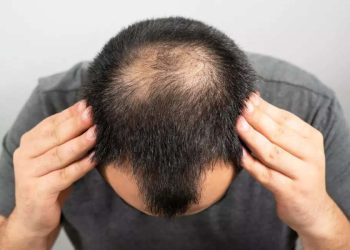 Male Baldness : మగవారిలో అకాల బట్టతల క్యాన్సర్ కి కారకమా..!?
